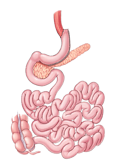 gastric sleeve