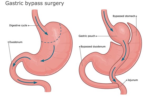 gastric bypass surgery graphic