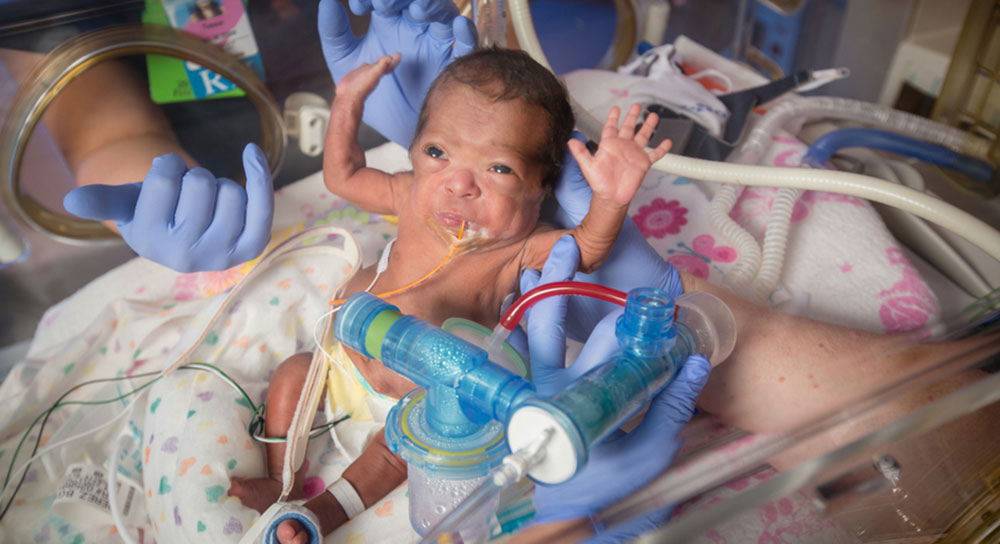 A tiny baby is surrounded by tubes and wires